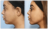 GlowLift™- Face Lifter