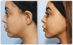 GlowLift™- Face Lifter